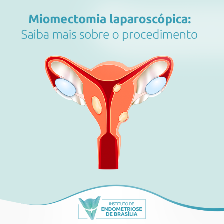 Miomectomia Laparosc Pica Saiba Mais Sobre O Procedimento Instituto