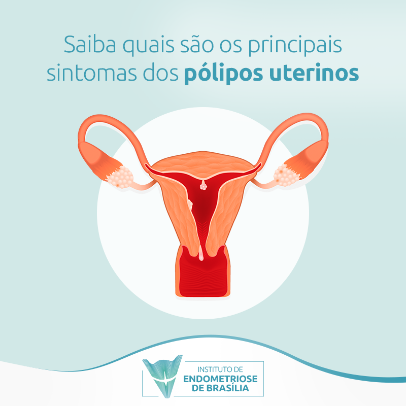 Saiba Quais São Os Principais Sintomas Dos Pólipos Uterinos Instituto De Endometriose De Brasília 8218
